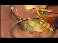 SANI TREATMENT กรณี